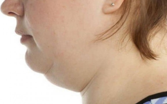 Làm sao để hết nọng cằm nhanh chóng?