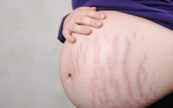 Giải đáp nhanh bị rạn da màu đỏ có tự hết không?