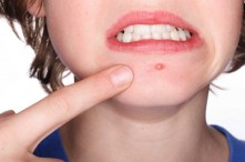 Bật Mí Cách Che Mụn Sưng Đỏ Trên Mặt Nhanh Và Hiệu Quả Nhất