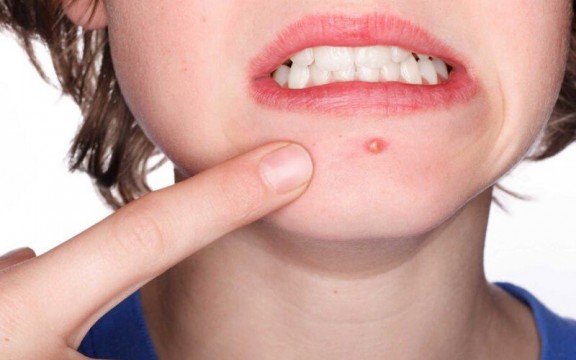 Bật Mí Cách Che Mụn Sưng Đỏ Trên Mặt Nhanh Và Hiệu Quả Nhất