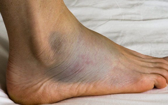 3 Cách Chữa Phù Chân Đơn Giản Hiệu Quả Cao