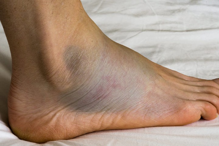 3 Cách Chữa Phù Chân Đơn Giản Hiệu Quả Cao