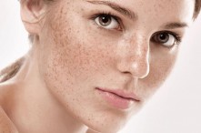 Top 5+ cách trị tàn nhang đơn giản tại nhà cực hữu ích 