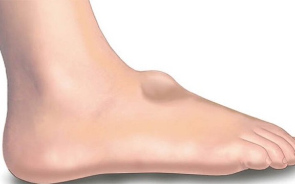 Sưng mu bàn chân là bệnh gì, có nguy hiểm không? 