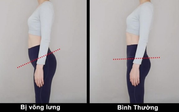 5 Phút Đọc Nhanh Võng Lưng Là Gì? Nguyên Nhân Và Cách Điều Trị