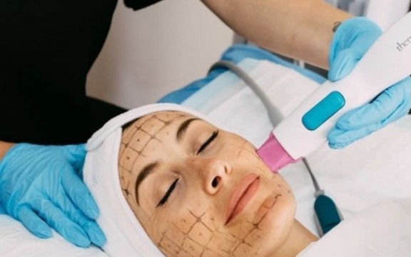 Thermage Là Gì? Thermage Flx Giữ Được Bao Lâu? Tác Dụng Phụ của Thermage?