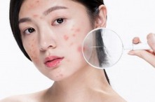 [Góc Thắc Mắc] Điện Di Sau Nặn Mụn Có Tác Dụng Gì?
