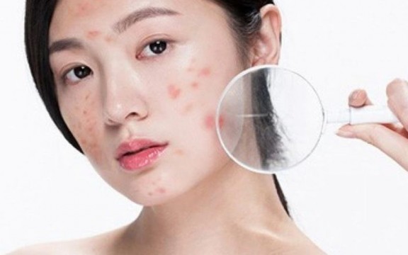 [Góc Thắc Mắc] Điện Di Sau Nặn Mụn Có Tác Dụng Gì?