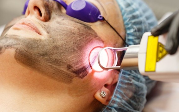 Laser Fractional CO2 Là Gì? Tác Hại Của Laser CO2 Đối Với Da