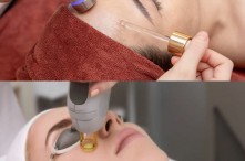 [Góc So Sánh] So Sánh Phương Pháp Điện Di Tinh Chất Và Laser CO2