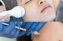 [Góc So Sánh] So Sánh Phương Pháp Điện Di Tinh Chất Và Tiêm Vi Điểm