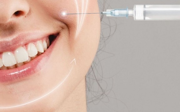 Tiêm Rãnh Cười Bao Lâu Thì Đẹp? Có Biến Chứng Tiêm Filler Rãnh Cười Không?