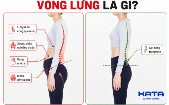 Võng Lưng Là Gì? Nguyên Nhân Và Cách Cải Thiện