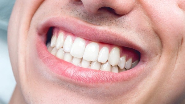 Gõ răng đảo lưỡi