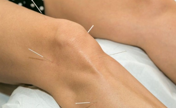 Châm cứu huyệt Túc Tam Lý