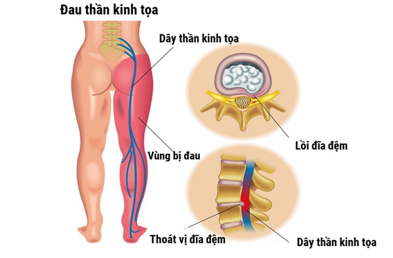Hỗ trợ giảm đau thần kinh tọa