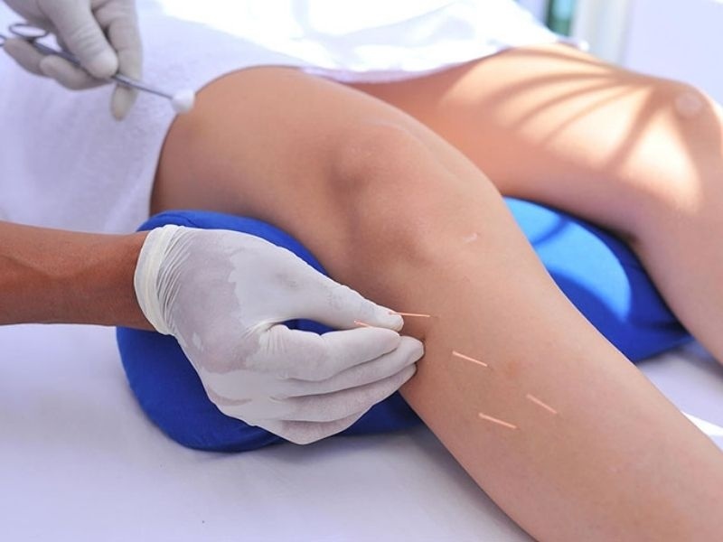 Châm cứu huyệt dương lăng tuyền