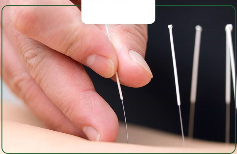 Cách châm cứu huyệt thừa sơn