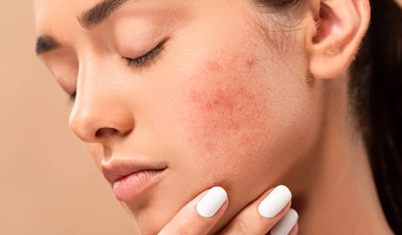 Hiệu quả hỗ trợ trị mụn và trẻ hóa da