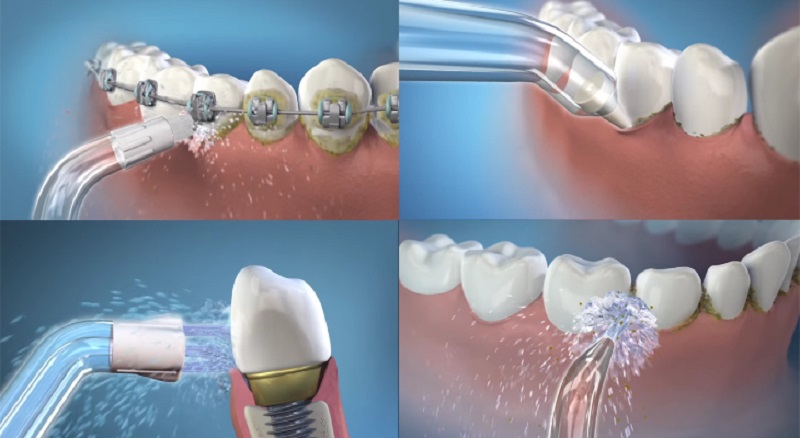 Đầu phun dành cho răng Implant, cầu răng và mão răng