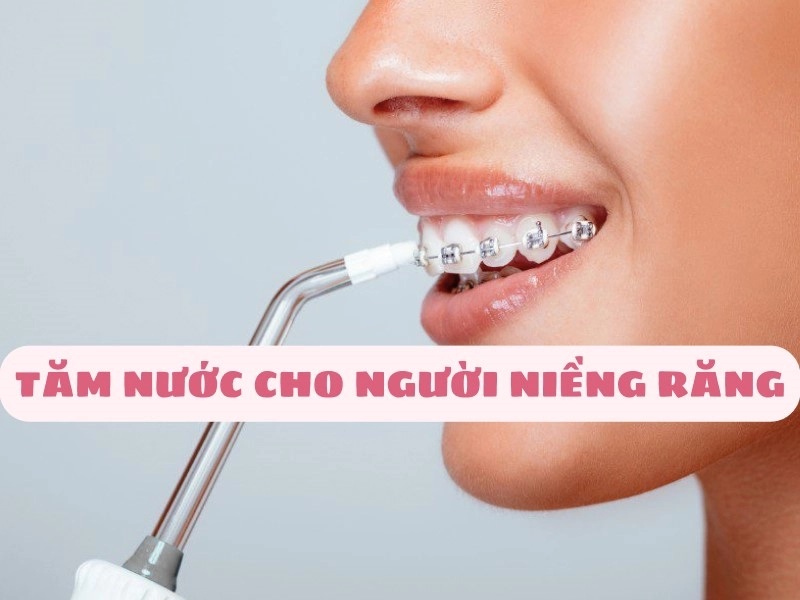 Đầu phun chỉnh nha cho người niềng răng (Orthodontic Tip)