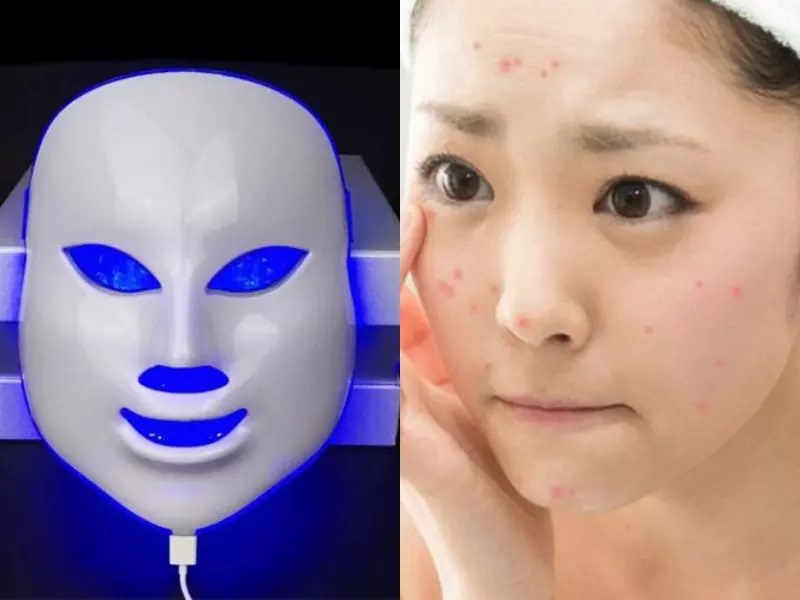 Mặt nạ ánh sáng sinh học Nhật Bản có hỗ trợ chăm sóc da mụn không