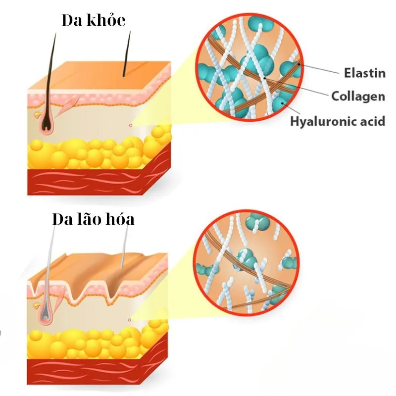 HIFU kích thích sản sinh collagen và elastin tự nhiên