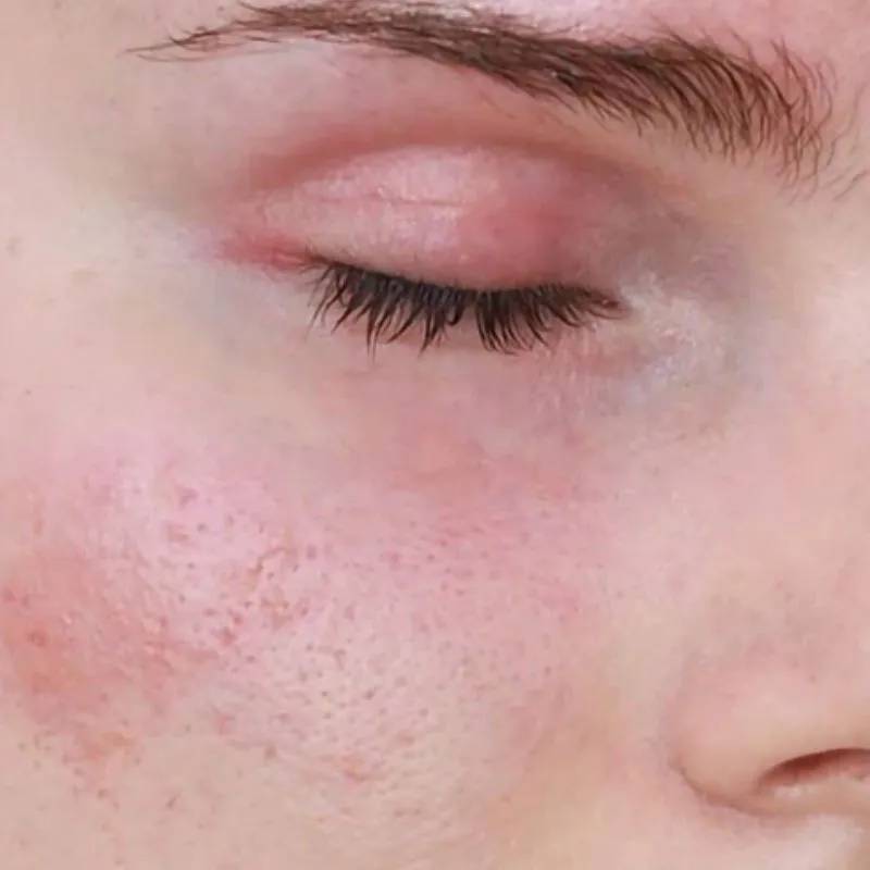 Tác dụng phụ của nâng cơ HIFU