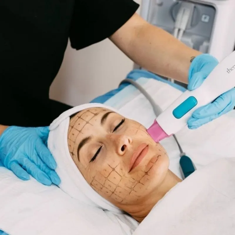 Thermage Flx Giữ Được Bao Lâu?