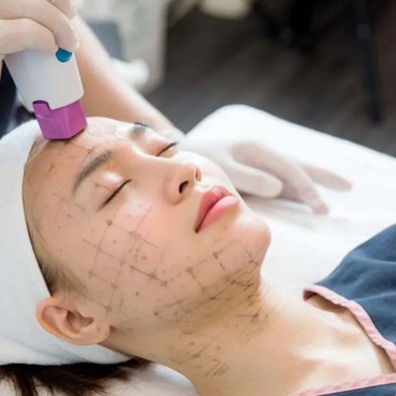Thermage là gì?