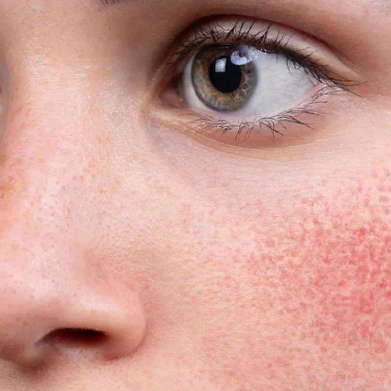 Tác dụng phụ của thermage