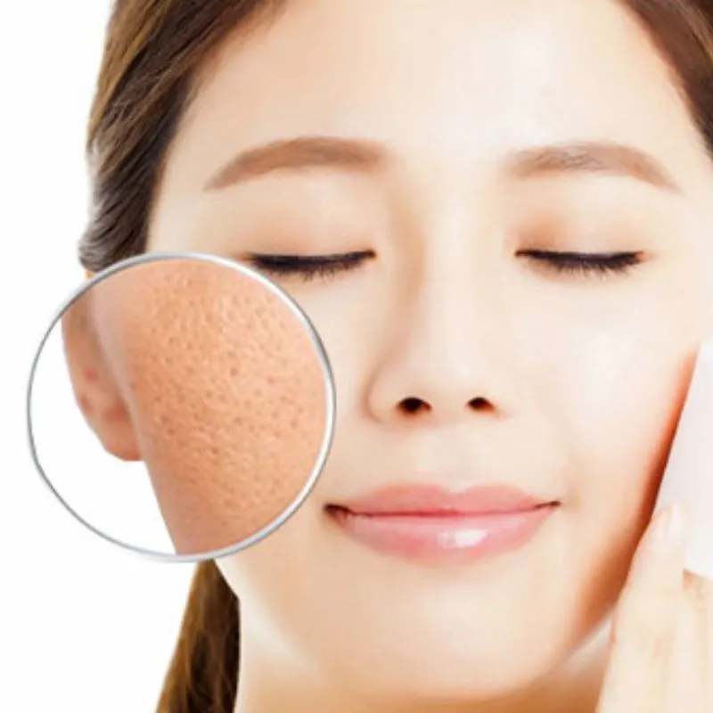 Allantoin cải thiện tình trạng lỗ chân lông to
