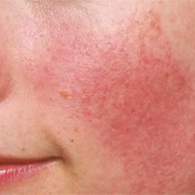 Một số người bị mẩn đỏ, châm chích khi dùng allantoin lần đầu