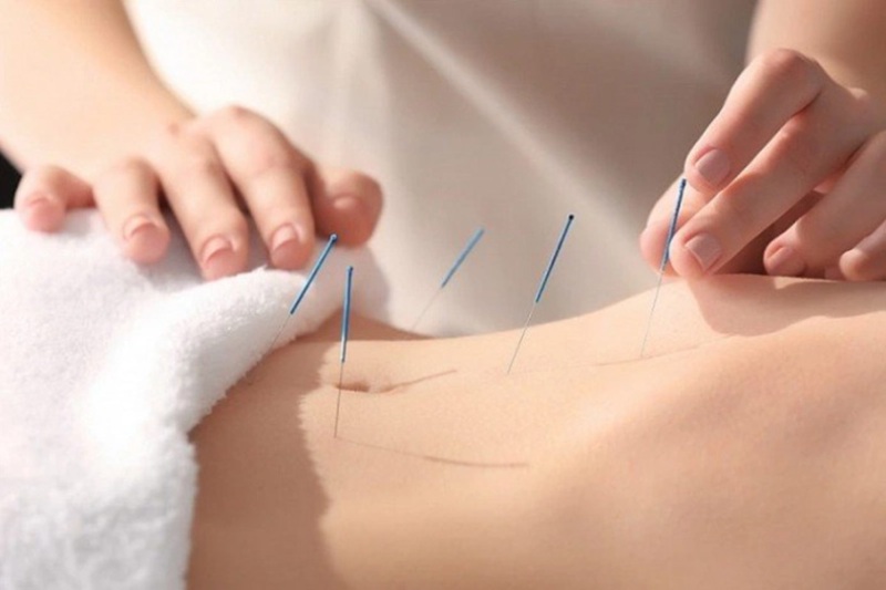 Châm cứu huyệt trung quản là phương pháp thường được thực hiện bởi bác sĩ hoặc kỹ thuật viên Đông y