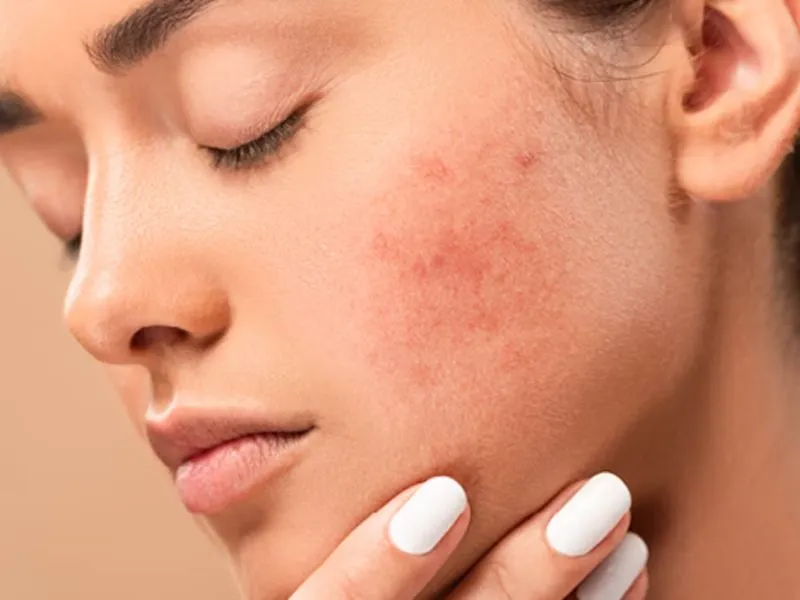 Sử dụng mặt nạ khi da đang kích ứng hoặc tổn thương