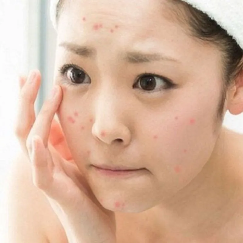 Chăm sóc da mụn sau trang điểm