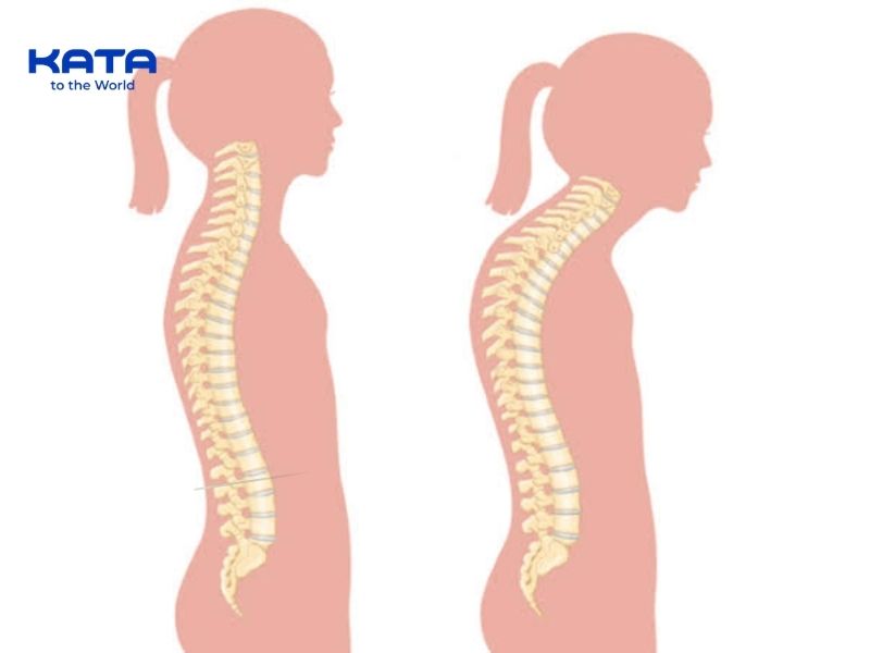 Cổ rùa kéo dài có thể gây căng cứng, đau mỏi cổ vai gáy và tăng áp lực lên cột sống cổ.