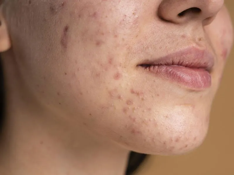 Hỗ trợ điều trị mụn và sẹo