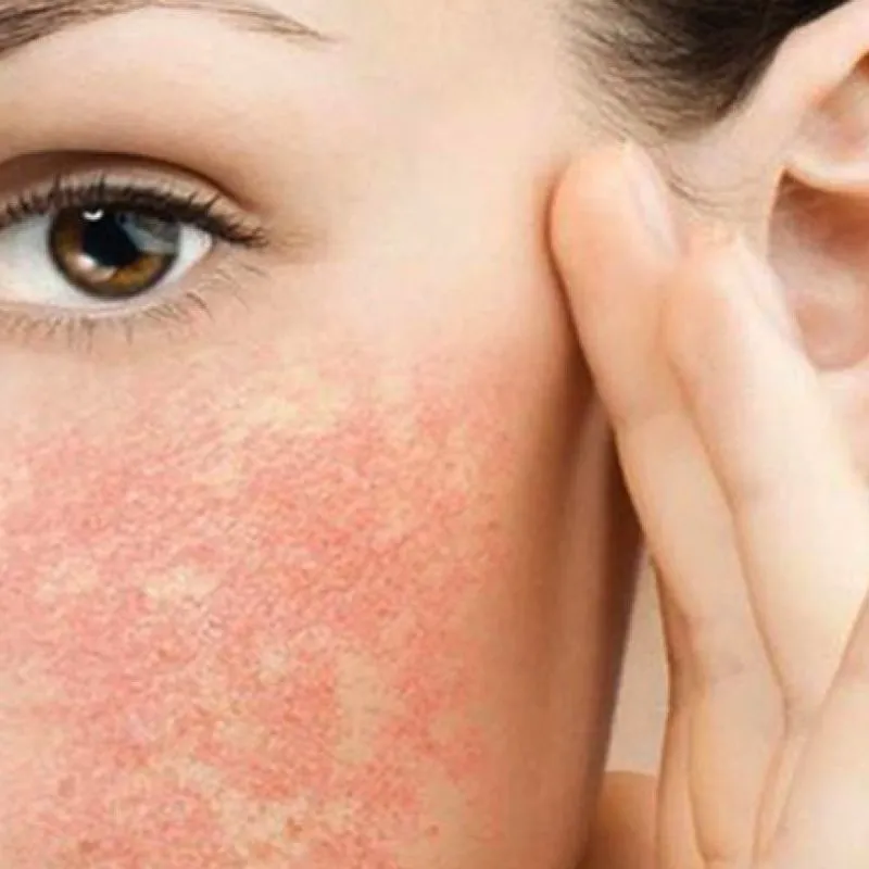Điện di peptide cải thiện tình trạng viêm, mẫn cảm và làm dịu da