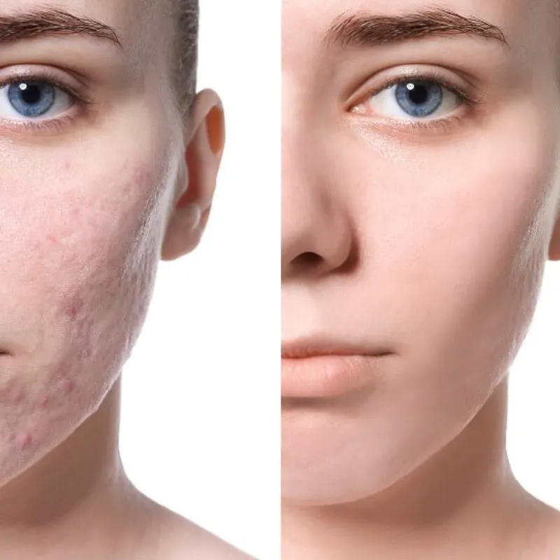 Người có da bị tổn thương do mụn, sẹo rỗ, sẹo lõm nên điện di tế bào gốc