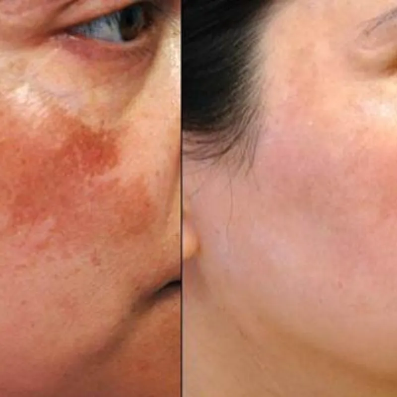 Điện di vitamin C giúp làm sáng da và giảm thâm nám, tàn nhang