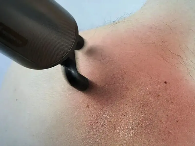 Kích ứng da do tiếp xúc 