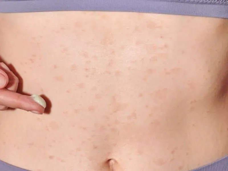 Cách xử lý khi dùng máy massage bị ngứa