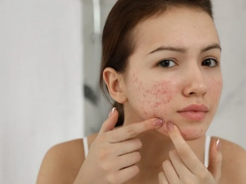 Kem chống nắng hóa học có thể gây kích ứng da 