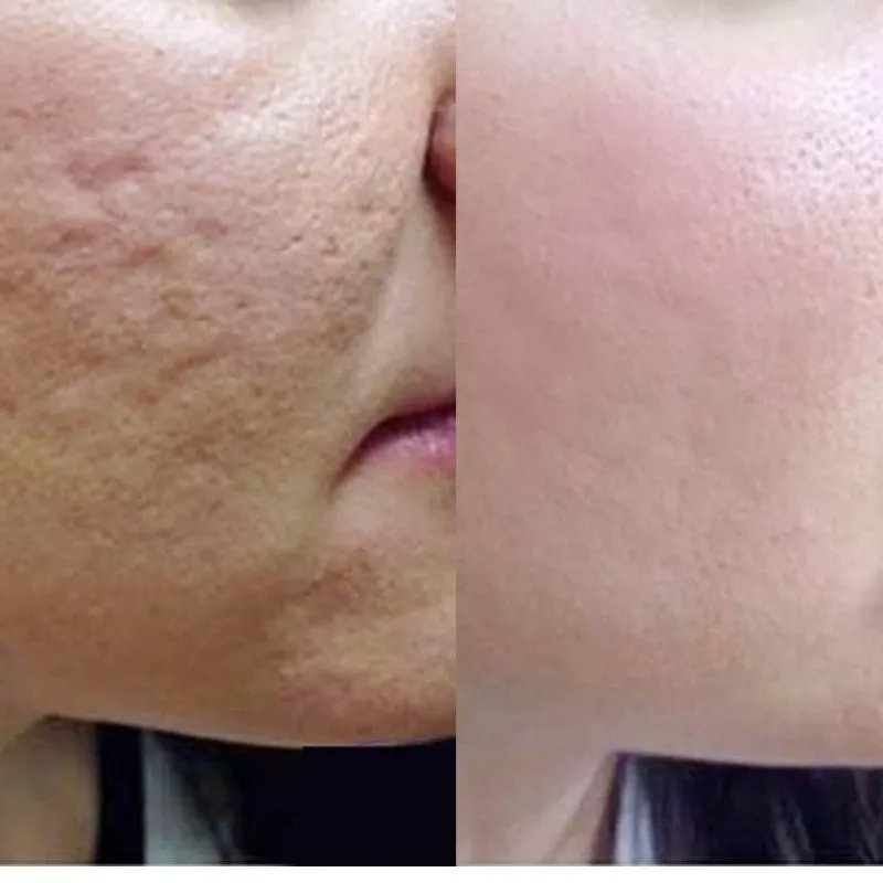 Tiêm prp bao lâu có tác dụng?