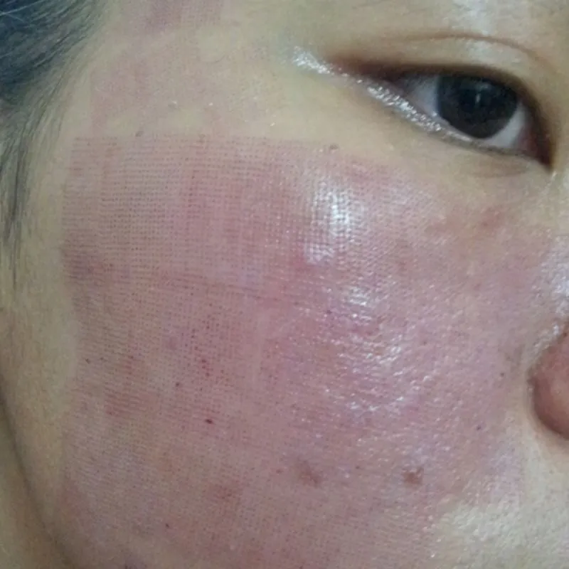 Một số tác dụng phụ nhẹ