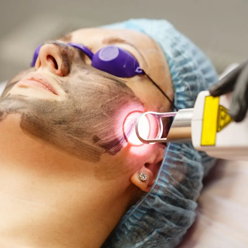 Laser Fractional CO2 Là Gì