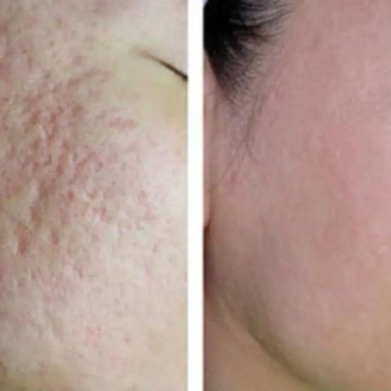 Laser co2 fractional cải thiện sẹo rỗ hiệu quả