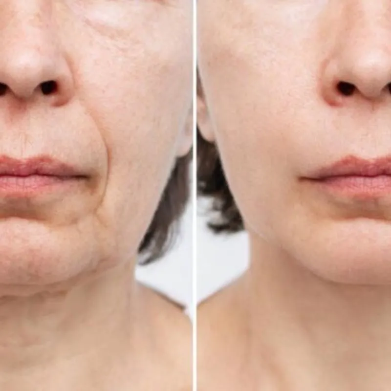 Laser co2 fractional trẻ hóa và cải thiện nếp nhăn trên da