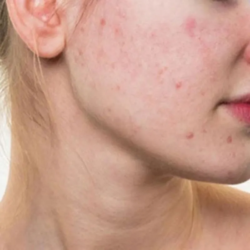 Sẹo là tác dụng phụ thường gặp
